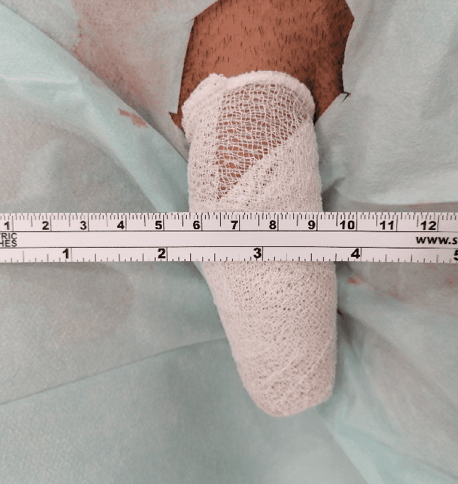 Penisvergrößerung mit Hyaluronsäure Penisunterspritzung mit Hyaluronsäure-Gel