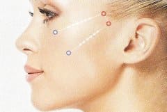 Anhebung des Mittelgesichts durch U-Pattern Fadenlifting
