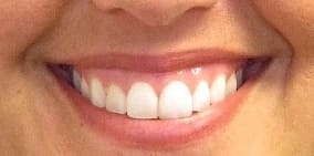 Zahnfleischlächeln